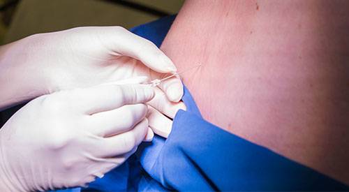 Anestesia epidural en embarazo
