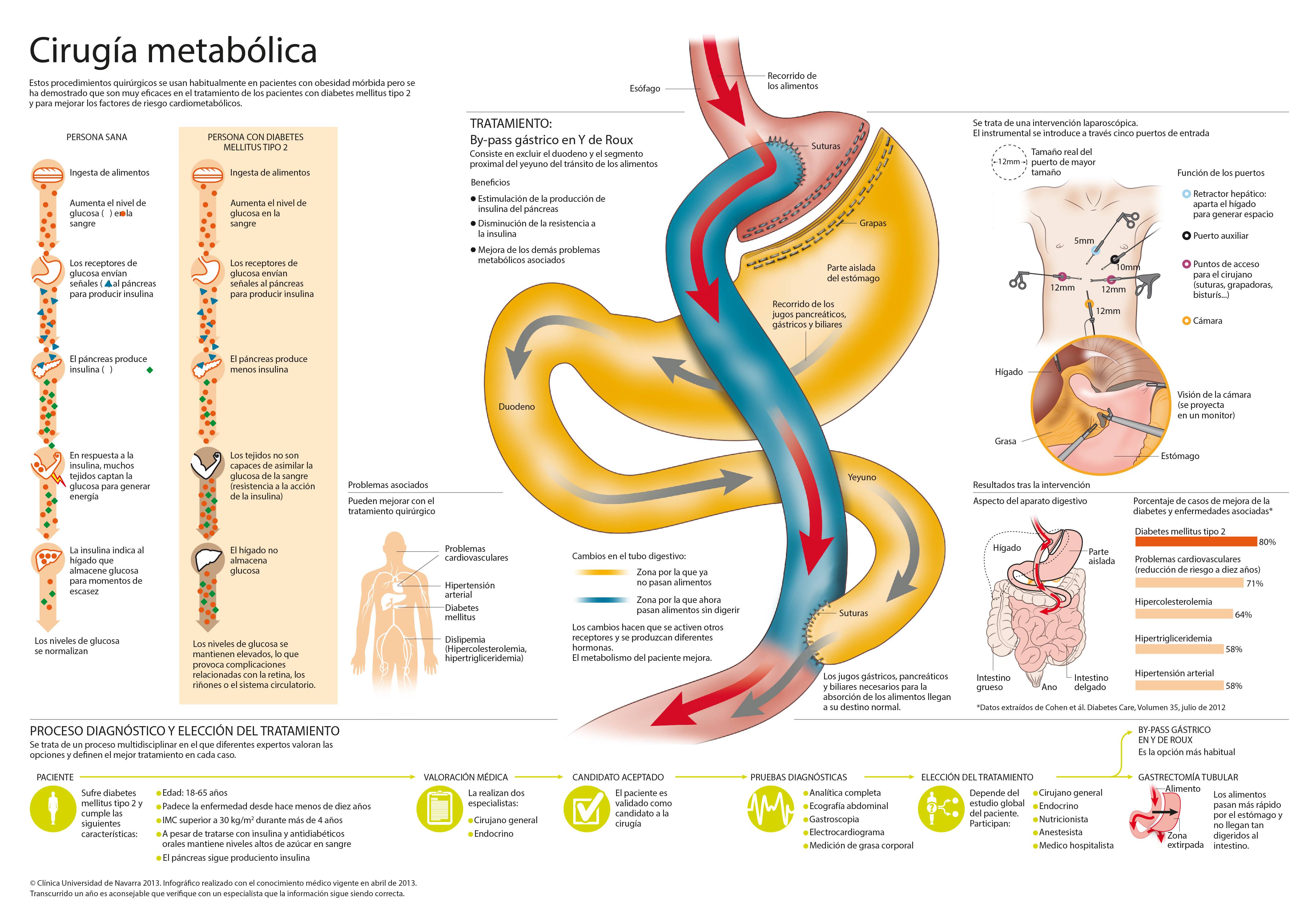 <p>Infogr&aacute;fico sobre la cirug&iacute;a metab&oacute;lica, el tratamiento quir&uacute;rgico para la diabetes mellitus tipo 2 con el que se obtienen unos excelentes resultados.&nbsp;</p>