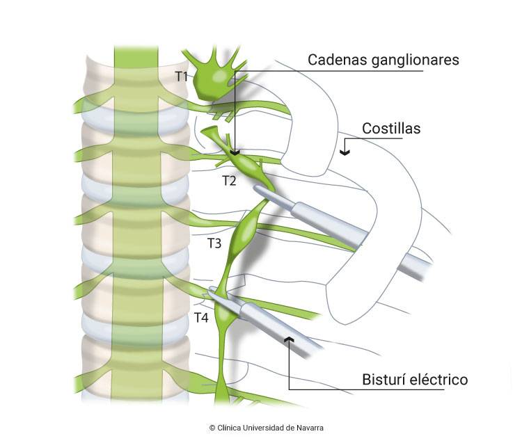 Cirugía mínimamente invasiva vía endoscópica con resultados son inmediatos para solucionar la hiperhidrosis. Clínica Universidad de Navarra