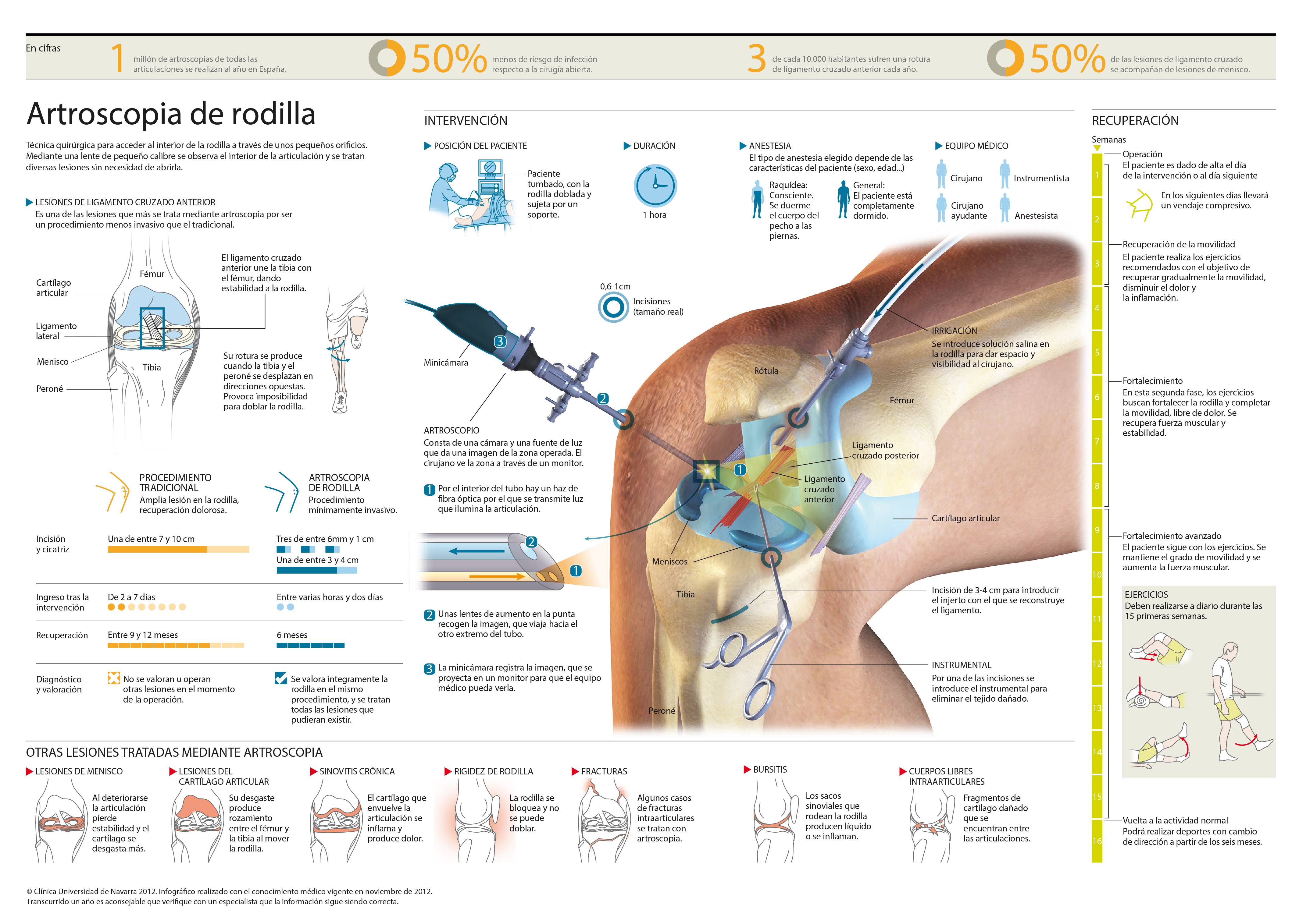 <p>Conozca qu&eacute; es la artroscopia de rodilla y en qu&eacute; problemas de la rodilla se realiza.&nbsp;</p>