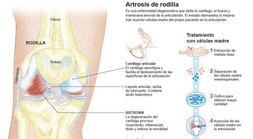 <p>Imagen preview del infográfico sobre la artrosis de rodilla y su tratamient con células madre</p>