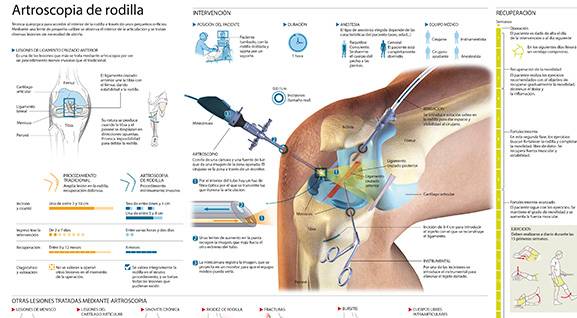 <p>Conozca qu&eacute; es la artroscopia de rodilla y en qu&eacute; problemas de la rodilla se realiza.&nbsp;</p>