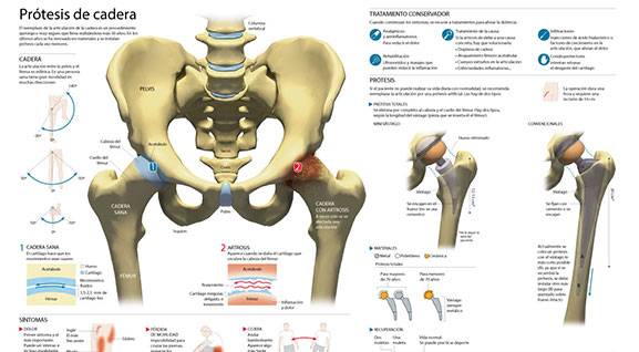 <p>Imagen preview del infogr&aacute;fico sobre la pr&oacute;tesis de cadera&nbsp;</p>