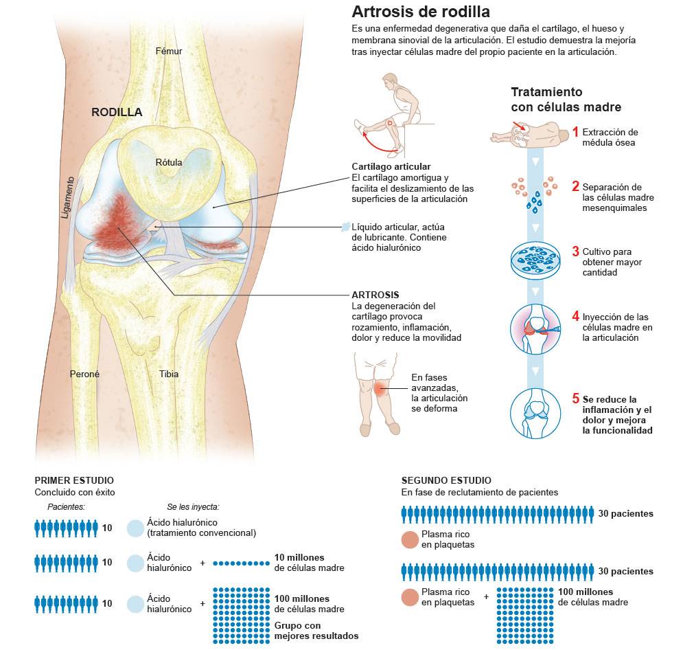 <p>Infográfico sobre la artrosis de rodilla, síntomas y su tratamiento con células madre para regenerar el cartílago.</p>