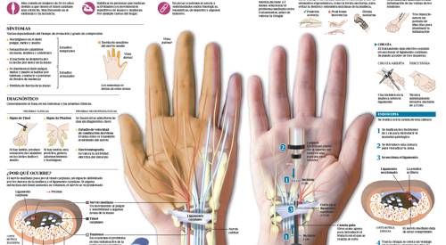 <p>Imagen preview del infogr&aacute;fico sobre el t&uacute;nel carpiano&nbsp;</p>