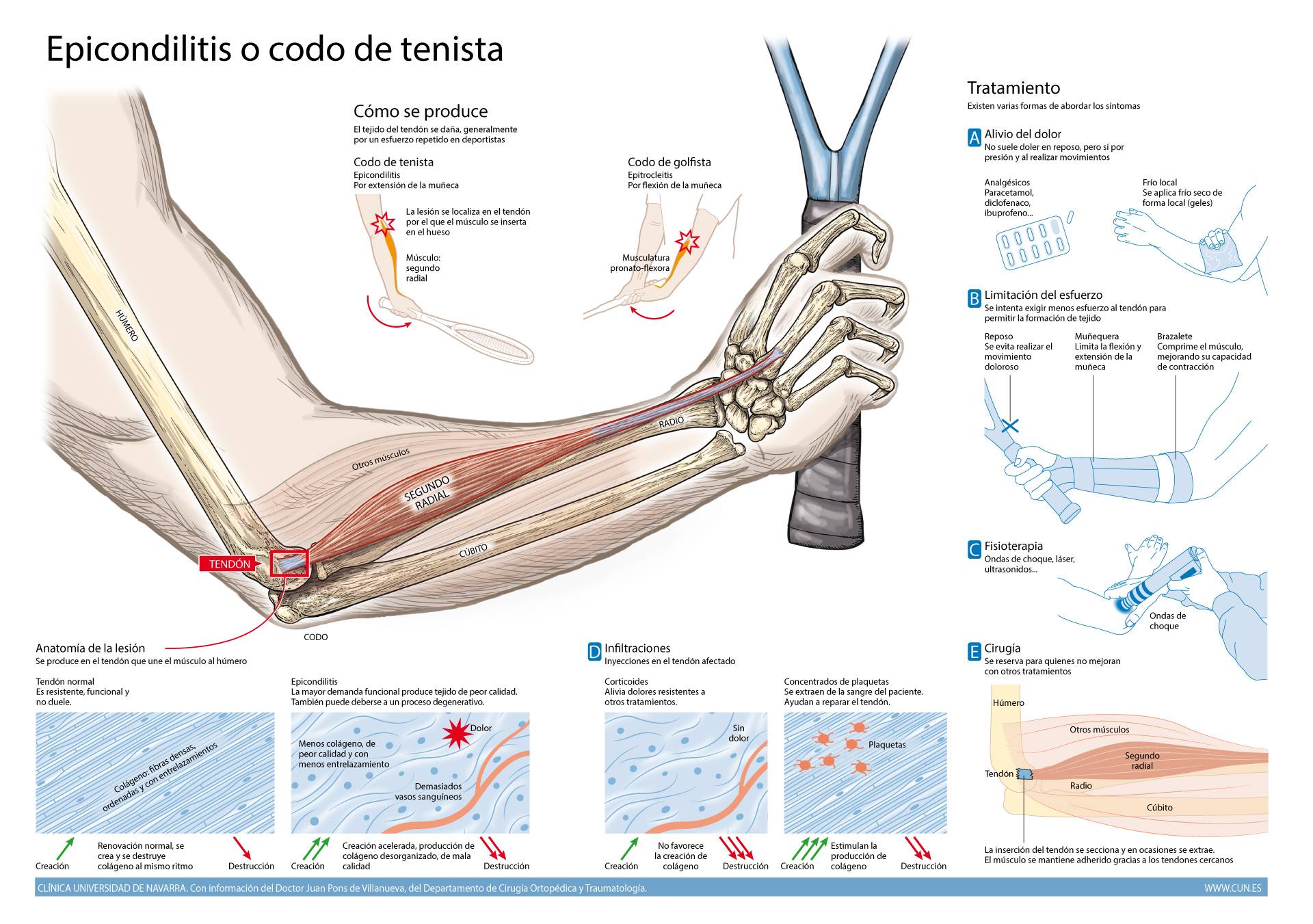 Imagen de la infografía sobre la epicondilitis o codo de tenista, realizada por la Clínica Universidad de Navarra.