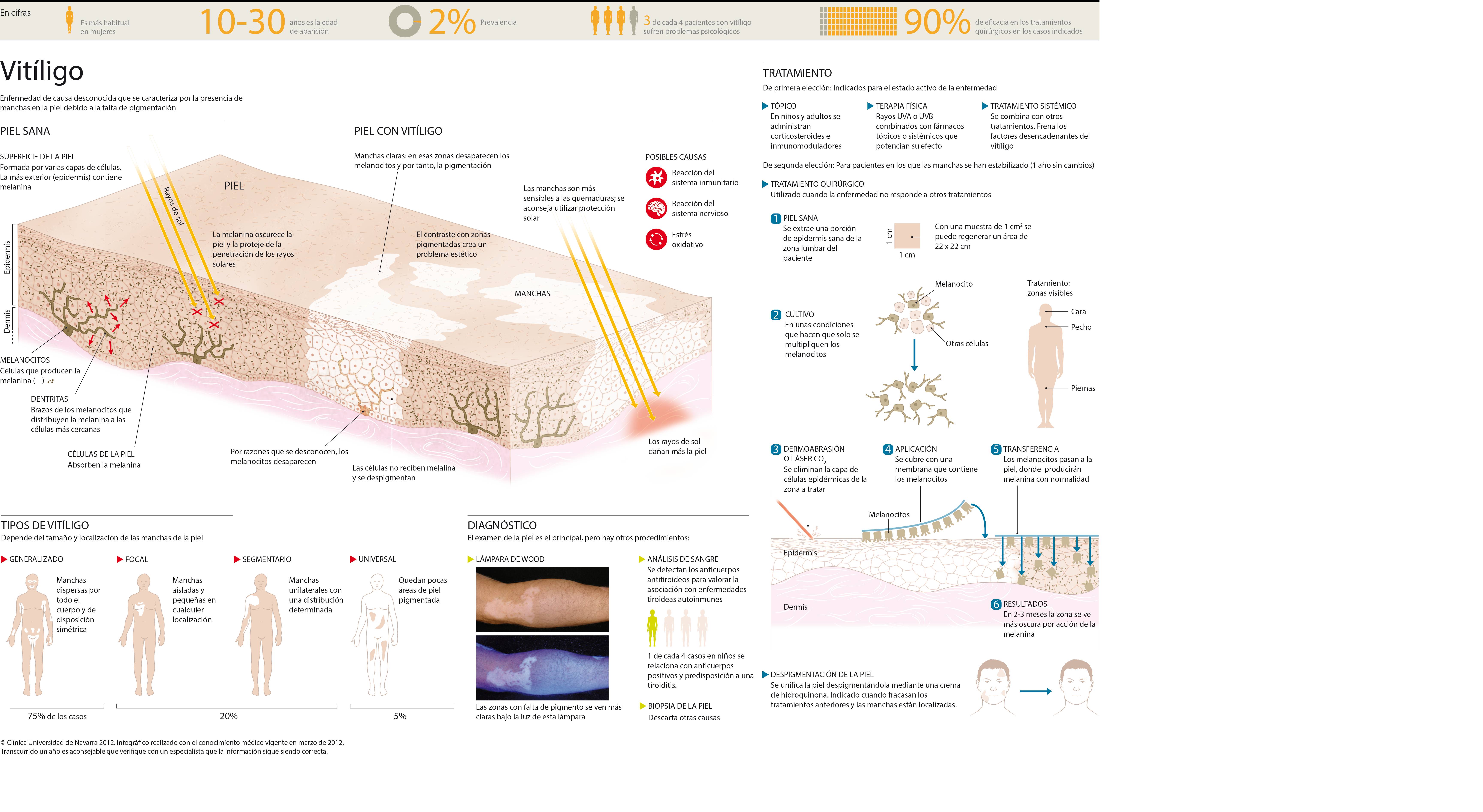 <p>Infograf&iacute;a del vit&iacute;ligo, enfermedad que despigmenta la piel y causa manchas blancas</p>