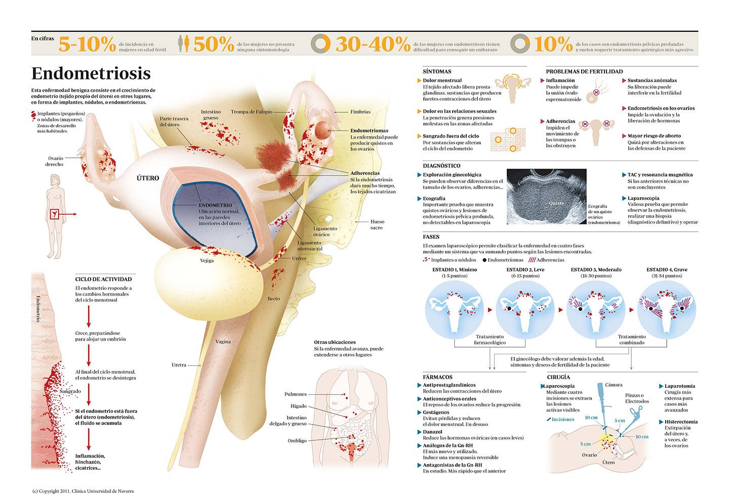 Infografía sobre la endometriosis. Conozca todo sobre esta enfermedad. Clínica Universidad de Navarra