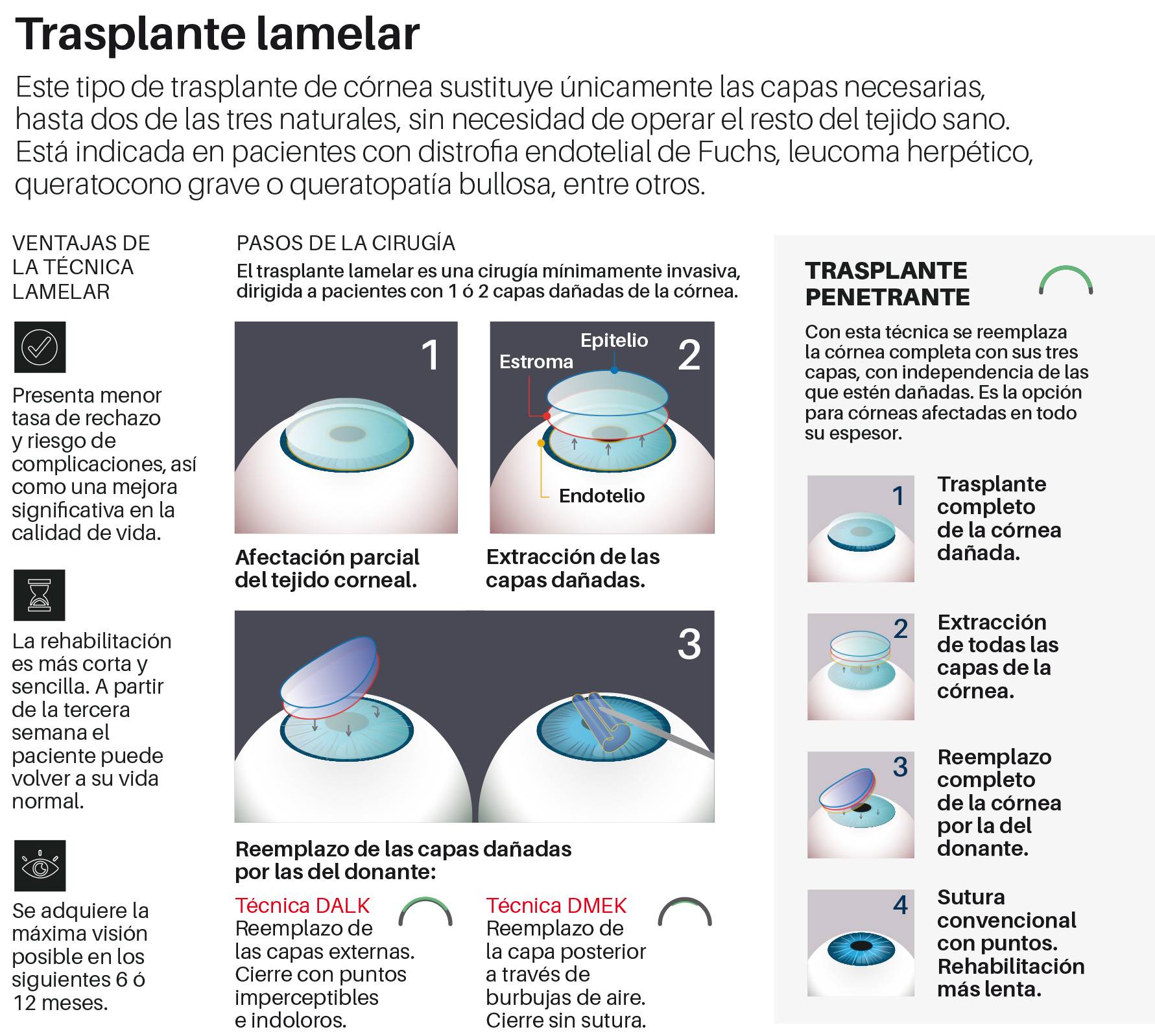 Infografía sobre el trasplante lamelar en la Clínica Universidad de Navarra.