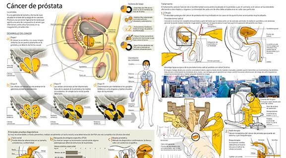 <p>Imagen preview del infogr&aacute;fico sobre el c&aacute;ncer de pr&oacute;stata&nbsp;</p>