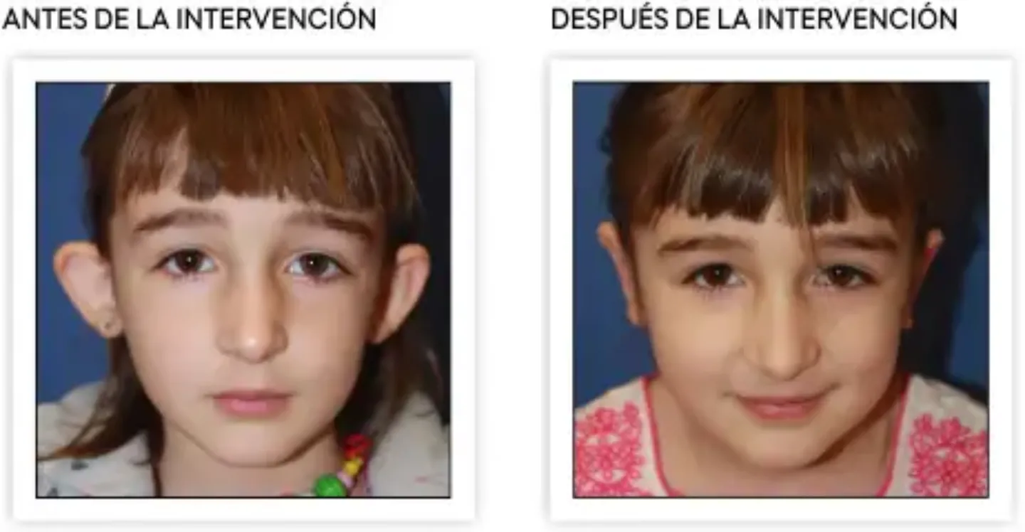 <p>Resultados tras la intervención de otoplastia, orejas en soplillo&nbsp;</p>