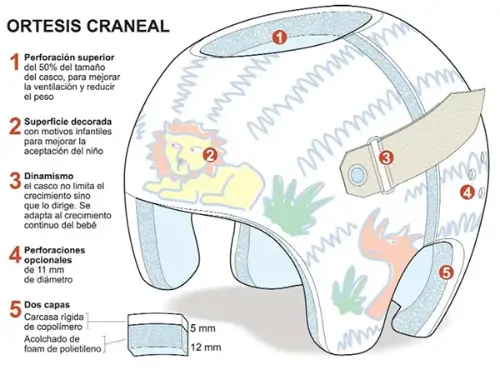 <p>La ortesis craneal es un casco especial de remodelado del cráneo, fabricado a medida, para corregir las deformidades en la cabeza de los recién nacidos.</p>