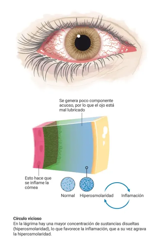 Infografía sobre el tipo de ojo seco acuodeficiente, el que tiene una disminución en la producción de lágrimas acuosas.