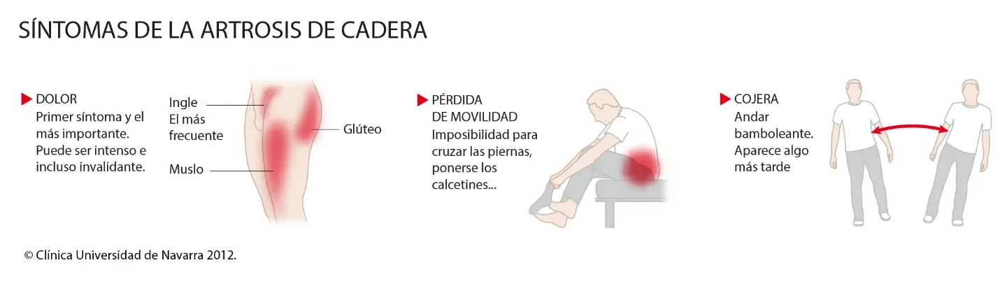 <p>Conozca los s&iacute;ntomas m&aacute;s frecuentes que puede presentar un paciente con artrosis de cadera.&nbsp;</p>