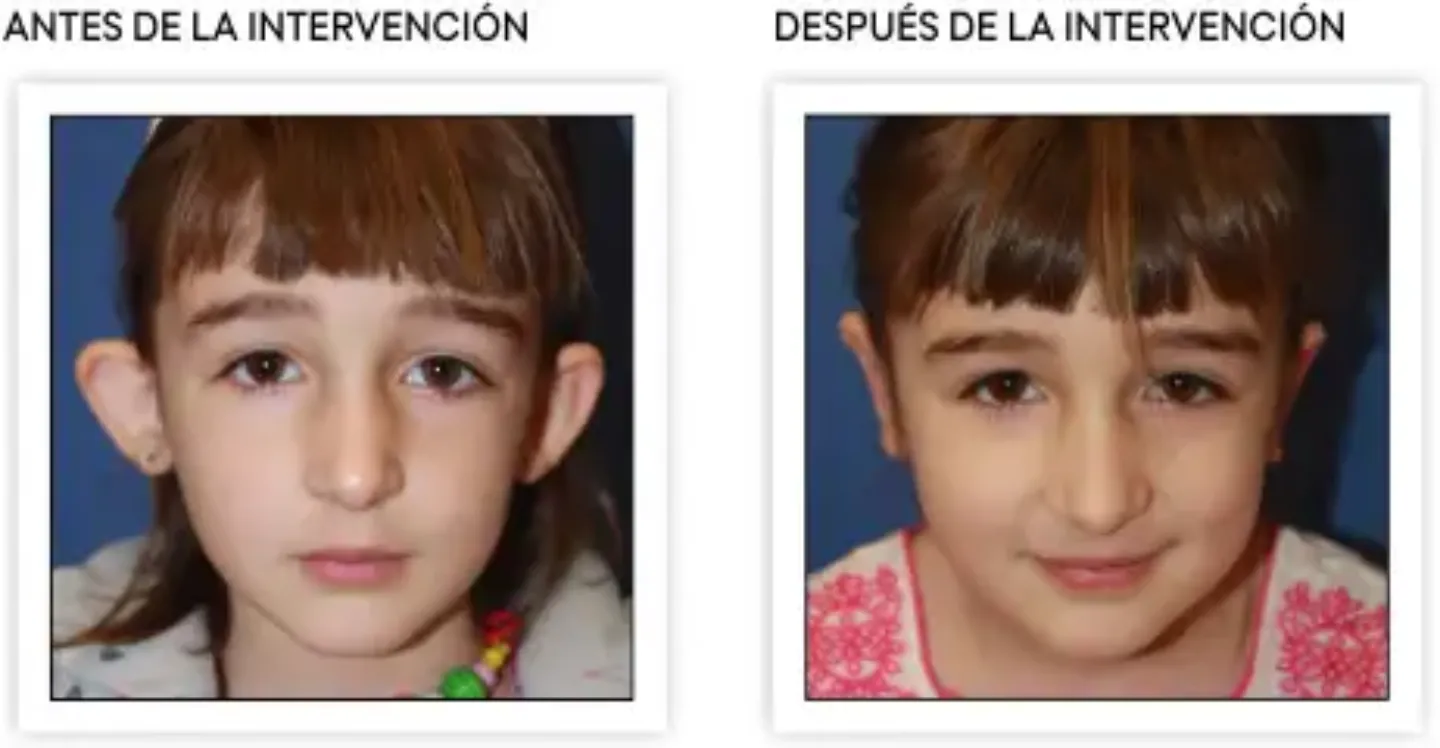 <p>Resultados tras la intervención de otoplastia, orejas en soplillo&nbsp;</p>