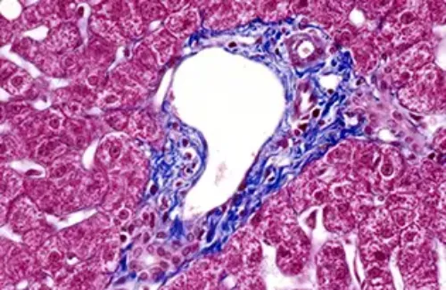 Imagen de muestra de anatomía patológica. Clínica Universidad de Navarra