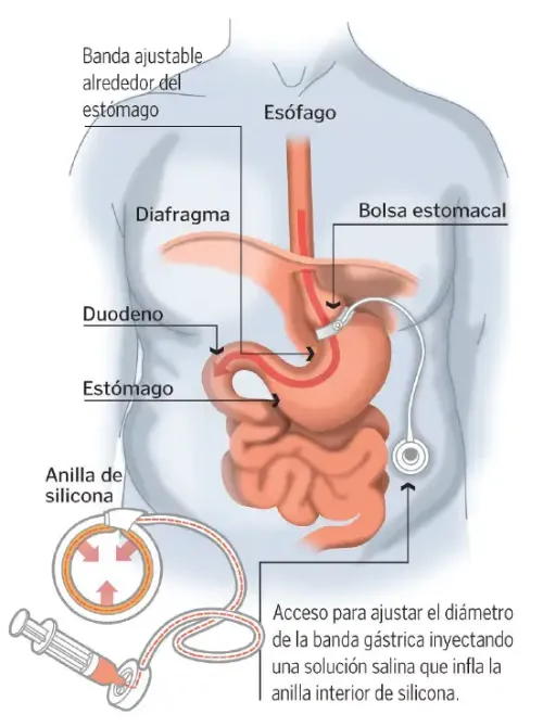Es una técnica quirúrgica con la que se controla la mayor o menor restricción de alimentos que llegan al estómago. 