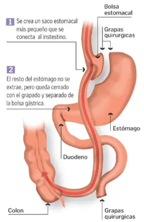 <p>Imagen t&eacute;cnica quir&uacute;rgica del bypass g&aacute;strico&nbsp;</p>