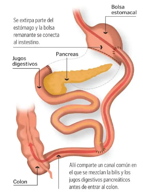 Técnica quirúrgica para reducir el tamaño del estómago y del intestino para la absorción de alimentos.
