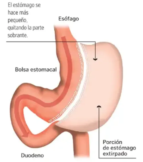 <p>Imagen de la t&eacute;cnica quir&uacute;rgica de la gastrectom&iacute;a tubular</p>