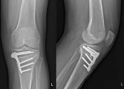 Radiografía de una osteotomía de rodilla para tratar la artrosis de rodilla. Clínica Universidad de Navarra