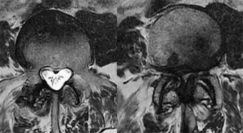 Resonancia magnética de un paciente con estenosis del canal medular