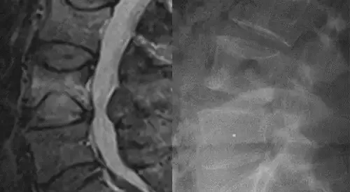 Imagen de una fractura vertebral. Clínica Universidad de Navarra