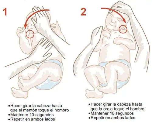 <p>Ejercicios de estiramiento que mejoran los síntomas de la contractura muscular cervical que presentan los niños con plagiocefalia&nbsp;</p>