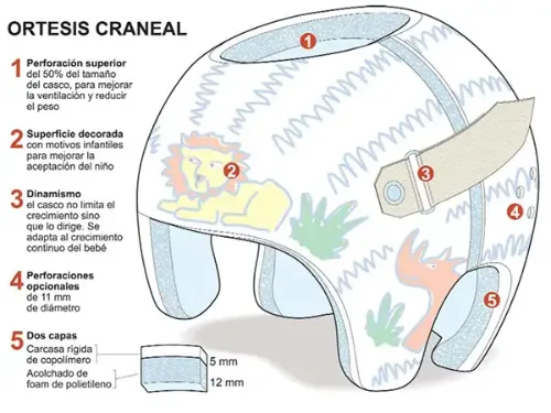 <p>La ortesis craneal es un casco especial de remodelado del cráneo, fabricado a medida, para corregir las deformidades en la cabeza de los recién nacidos.</p>
