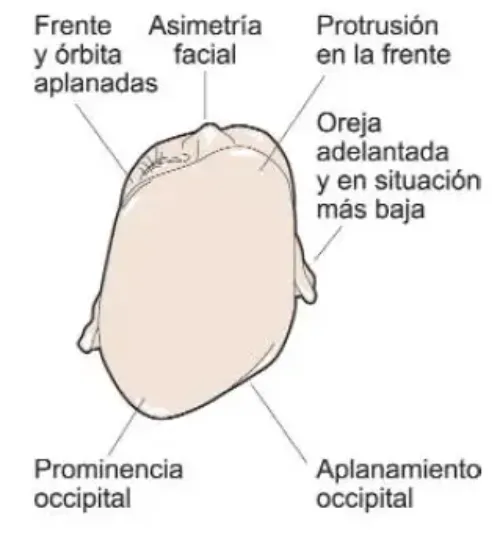 <p>Signos que aparecen en un recién nacido que sufre plagiocefalia posicional&nbsp;</p>