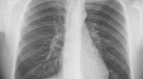 <p>Radiograf&iacute;a simple de t&oacute;rax&nbsp;</p>