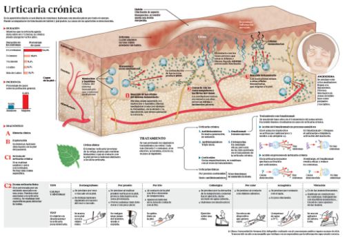 <p>Infogr&aacute;fico sobre la urticaria cr&oacute;nica, qu&eacute; es, c&oacute;mo se diagnostica y su tratamiento</p>