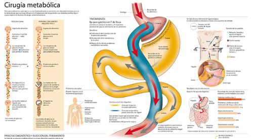 <p>Infogr&aacute;fico sobre la cirug&iacute;a metab&oacute;lica, el tratamiento quir&uacute;rgico para la diabetes mellitus tipo 2 con el que se obtienen unos excelentes resultados.&nbsp;</p>