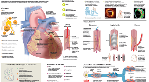 <p>Imagen preview del infogr&aacute;fico sobre el infarto agudo de miocardio&nbsp;</p>