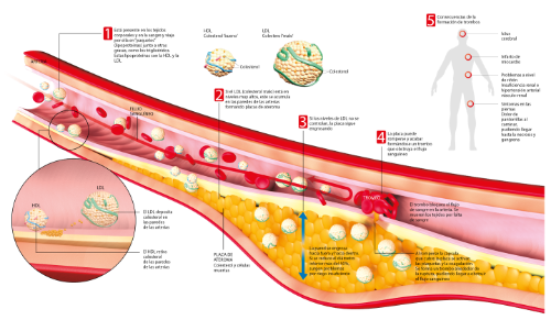 <p>Imagen preview del infografico sobre mecanismos de la ateroesclerosis&nbsp;</p>