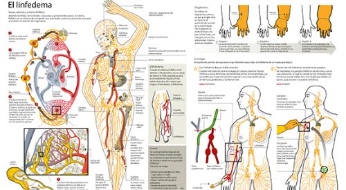 <p>Imagen preview del infogr&aacute;fico de linfedema&nbsp;</p>