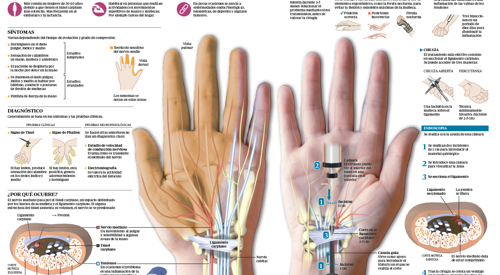 <p>Imagen preview del infogr&aacute;fico sobre el t&uacute;nel carpiano&nbsp;</p>