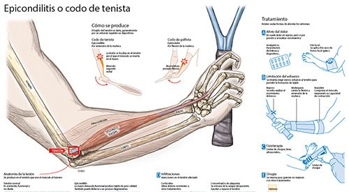 Imagen de la infografía sobre la epicondilitis o codo de tenista, realizada por la Clínica Universidad de Navarra.