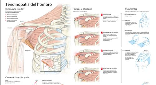 Imagen preview de infográfico sobre la tendinopatía de hombro. Clínica Universidad de Navarra