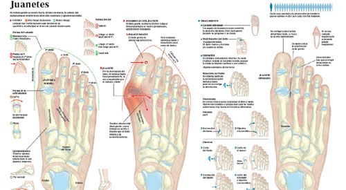 <p>Imagen preview del infogr&aacute;fico sobre los juanetes</p>