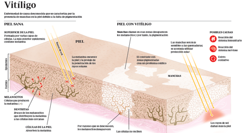 <p>Infograf&iacute;a del vit&iacute;ligo, enfermedad que despigmenta la piel y causa manchas blancas</p>