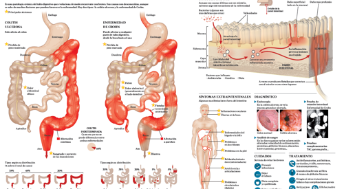 <p>Imagen preview del infogr&aacute;fico sobre la enfermedad inflamatoria intestinal&nbsp;</p>