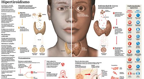 <p>Imagen preview del infográfico sobre hipertiroidismo realizado por la Clínica Universidad de Navarra</p>