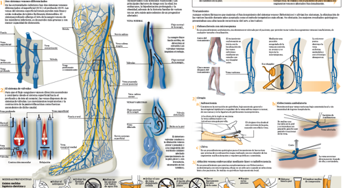 <p>Imagen preview del infogr&aacute;fico sobre varices&nbsp;</p>