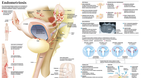 Infografía sobre la endometriosis. Conozca todo sobre esta enfermedad. Clínica Universidad de Navarra