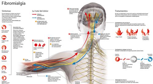<p>Imagen preview del infográfico sobre fibromialgia realizado por la Clínica Universidad de Navarra&nbsp;</p>