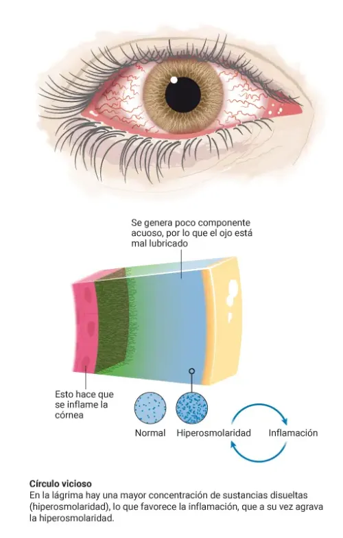 Infografía sobre el tipo de ojo seco acuodeficiente, el que tiene una disminución en la producción de lágrimas acuosas.