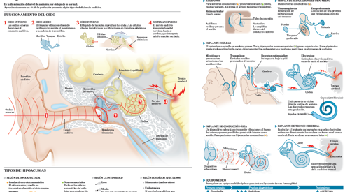 <p>Imagen preview del infogr&aacute;fico sobre hipoacusias&nbsp;</p>
