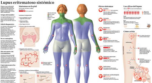Infografía sobre qué es el lupus eritematoso, causas, síntomas, afectación y tratamientos para prevenir los brotes y evitar la evolución. Información de confianza de la Clínica Universidad de Navarra