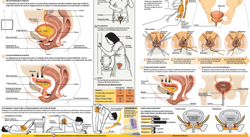 <p>Imagen preview del infogr&aacute;fico sobre incontinencia urinaria&nbsp;</p>